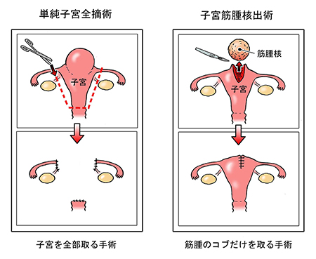 子宮 筋腫 手術